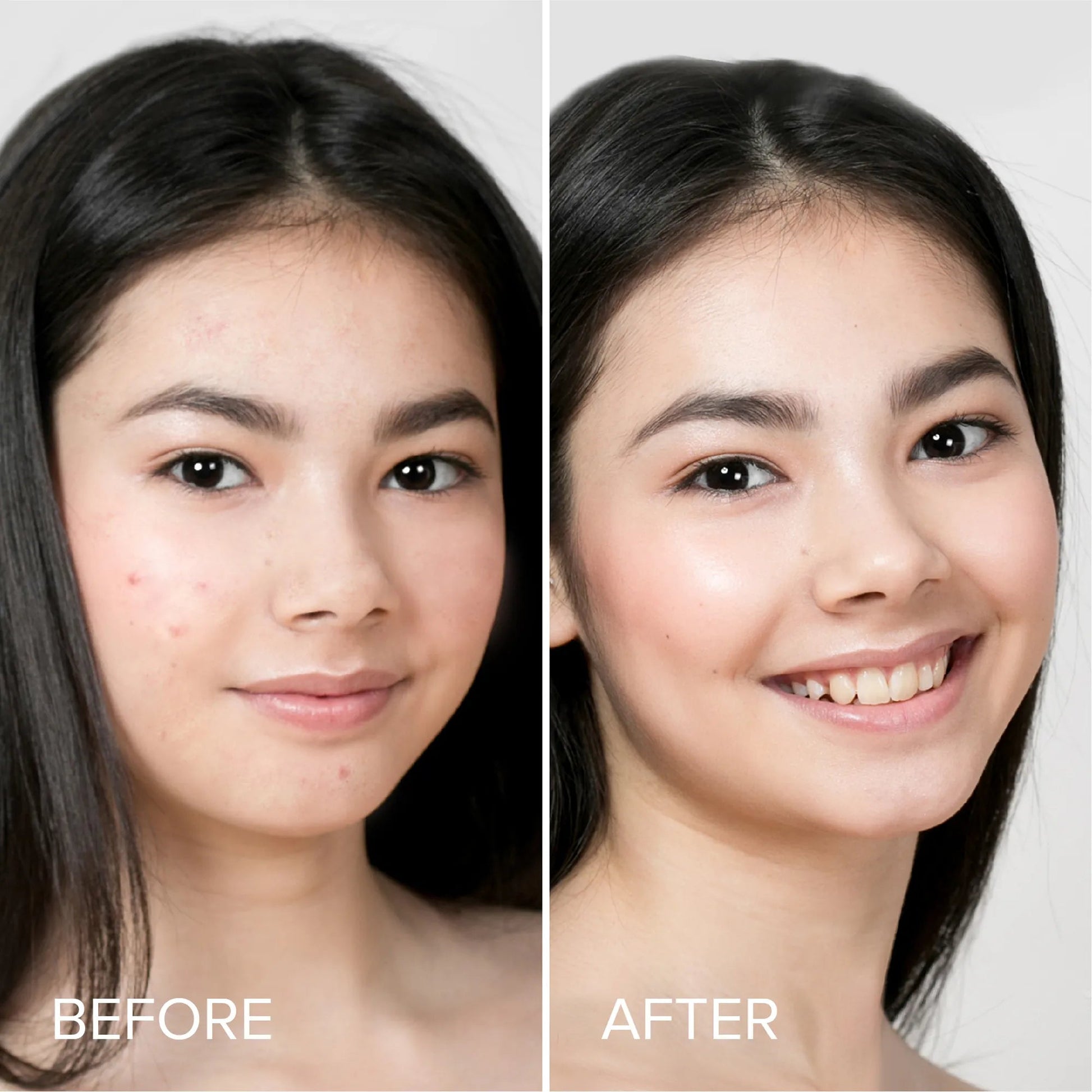 Pimple & Acne Patches - Bright House